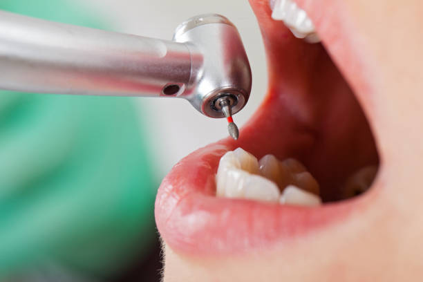 Best Emergency Dental Extractions in Gages Lake, IL